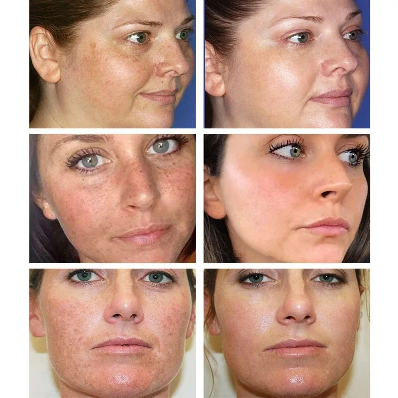 Crema blanqueadora para pecas, - Skincare Glowing reseña y precio